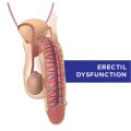 Erectile Dysfunction